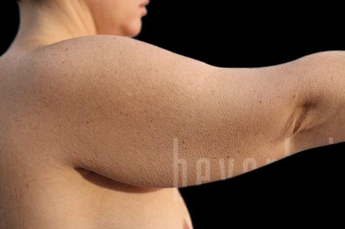 Case--1306 | Before Arm Lift 2