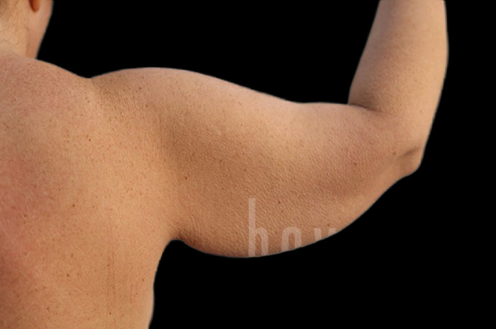 Case--1306 | Before Arm Lift 5