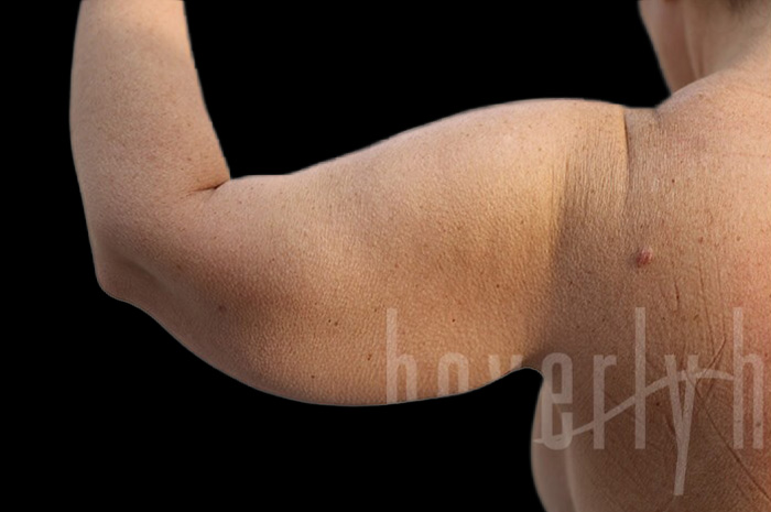 Case--1306 | Before Arm Lift 6