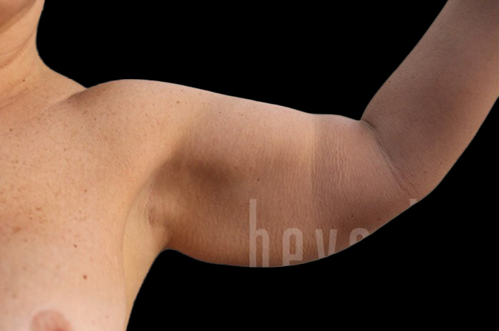 Case--1306 | Before Arm Lift