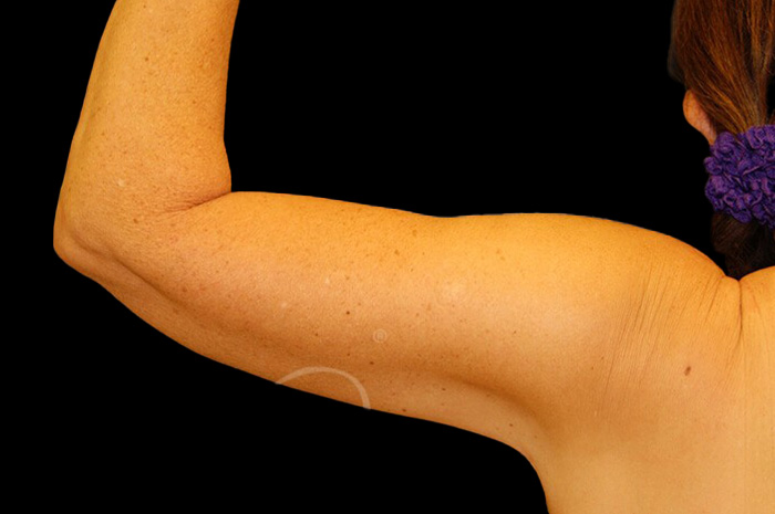 Case--5290 | After Arm Lift 2