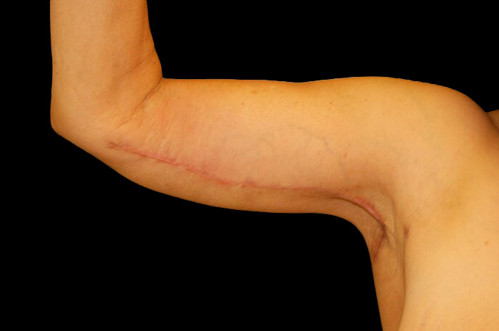 Case--5290 | After Arm Lift 3