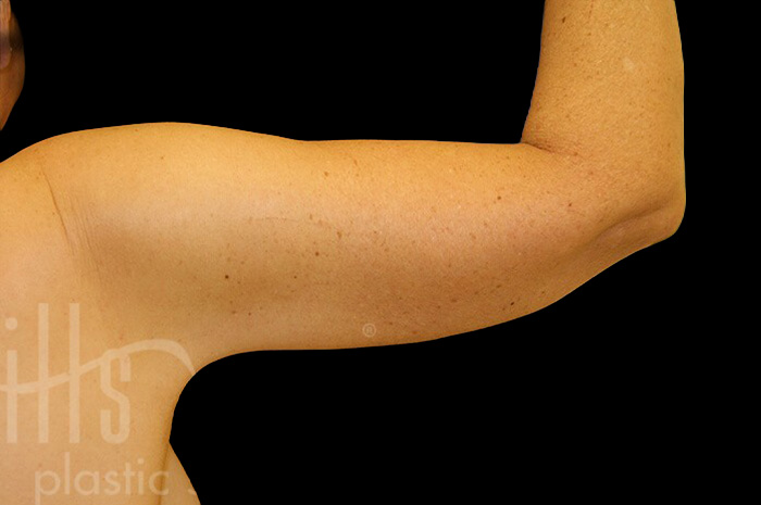 Case--5290 | After Arm Lift