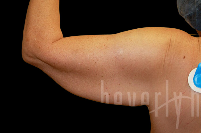 Case--5290 | Before Arm Lift 2