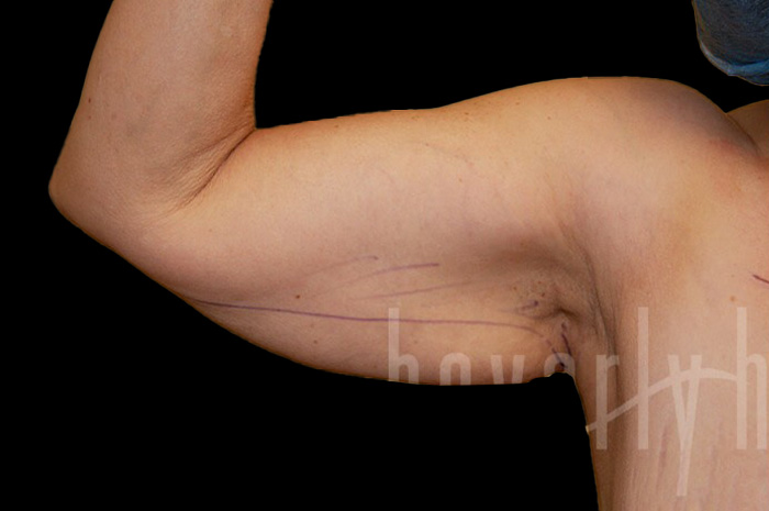 Case--5290 | Before Arm Lift 3