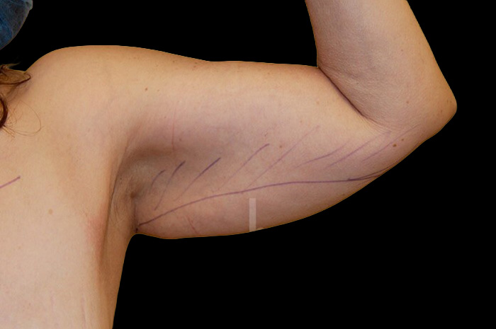 Case--5290 | Before Arm Lift 4