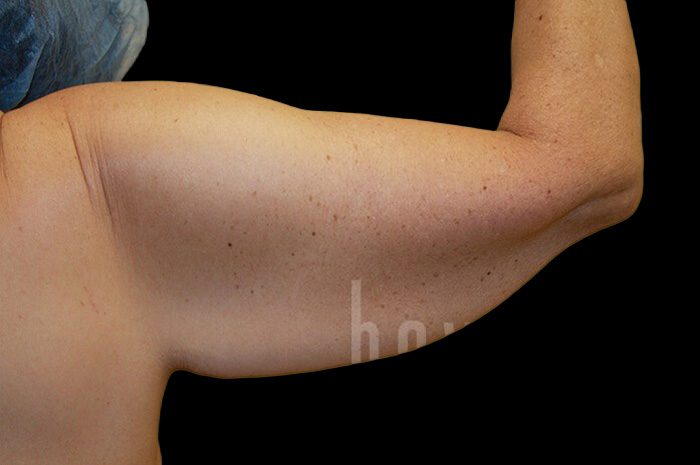 Case--5290 | Before Arm Lift