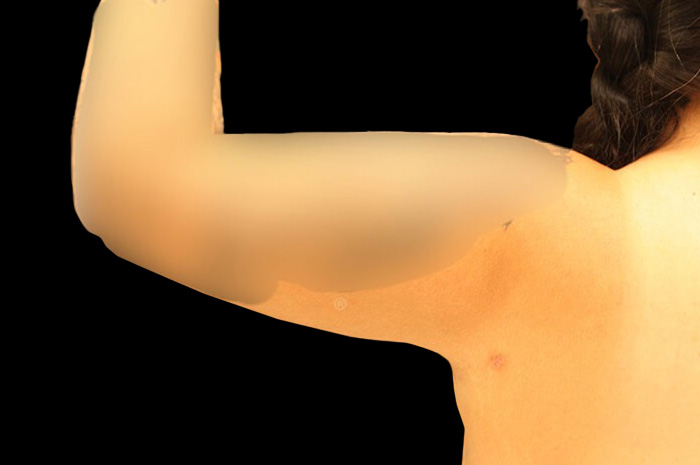 Case--9332 | After Arm Lift 2