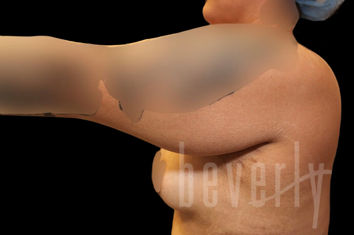 Case--9332 | Before Arm Lift 3