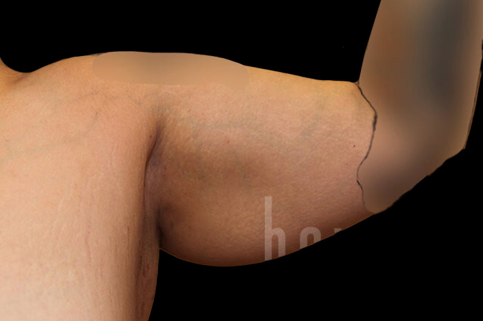 Case--9332 | Before Arm Lift 4