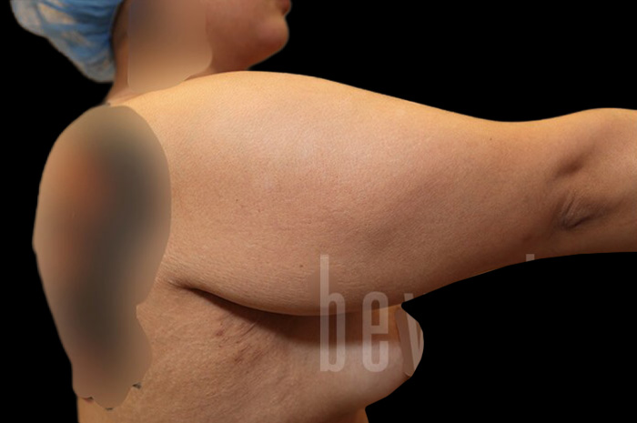 Case--9332 | Before Arm Lift 5