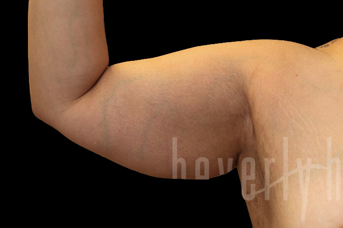 Case--9332 | Before Arm Lift 6