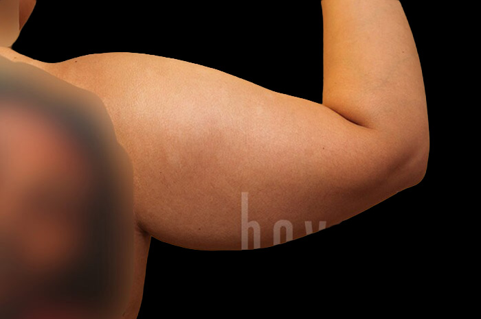 Case--9332 | Before Arm Lift