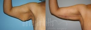 Arm Lift Patient 04 Before & After - Thumbnail