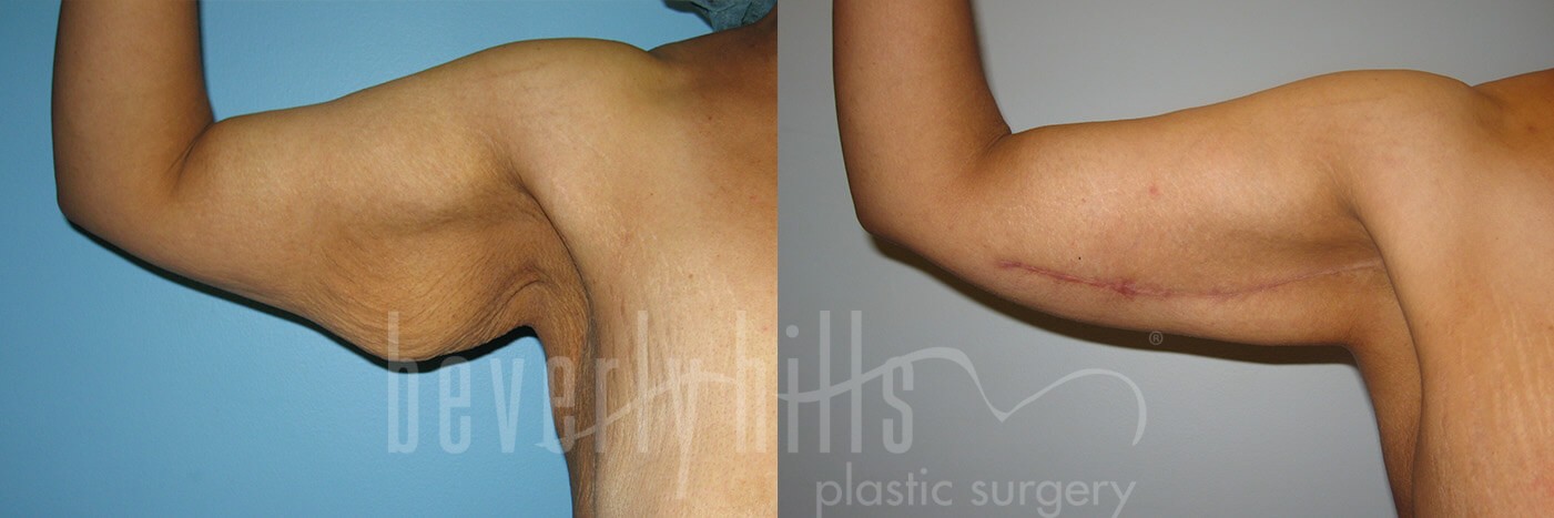 Arm Lift Patient 04 Before & After