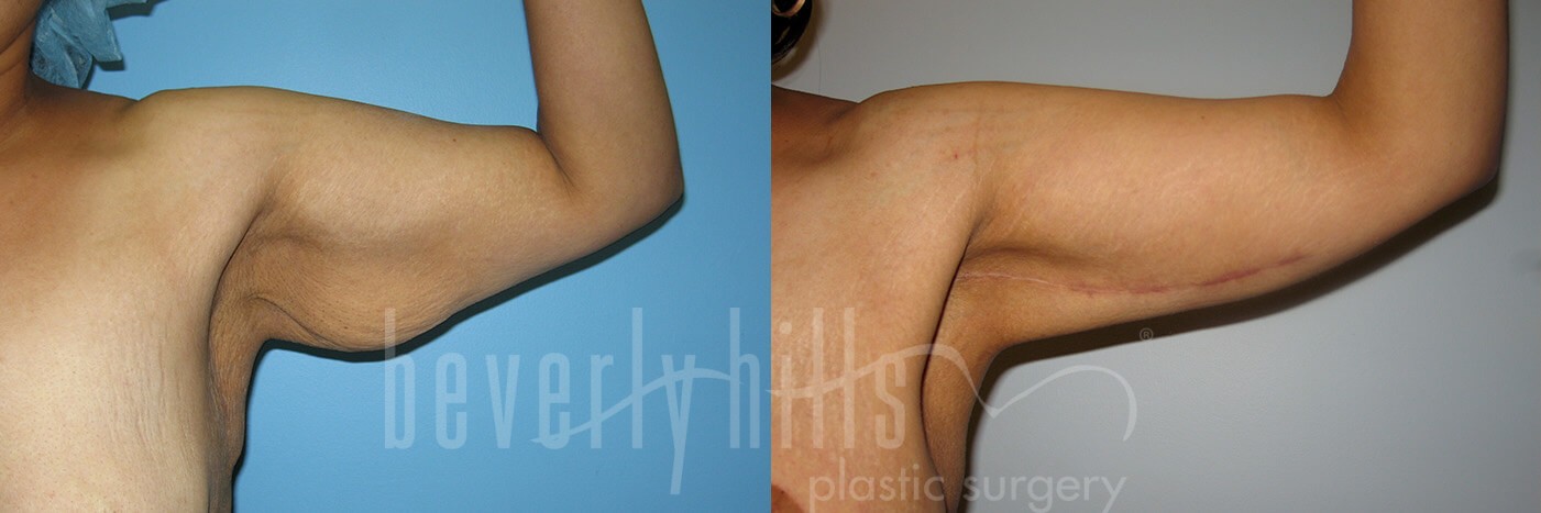 Arm Lift Patient 04 Before & After
