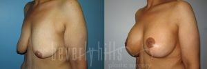 Arm Lift Patient 04 Before & After - Thumbnail