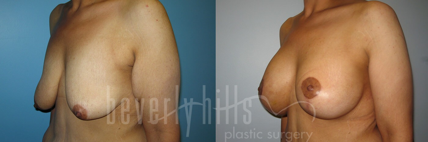 Arm Lift Patient 04 Before & After