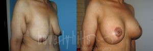 Arm Lift Patient 04 Before & After - Thumbnail