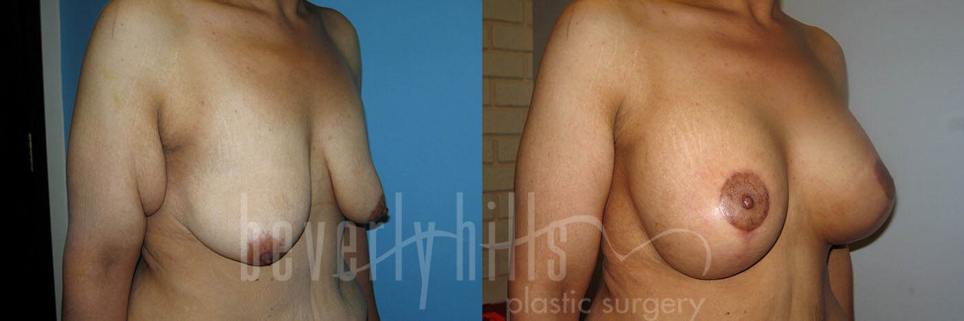 Arm Lift Patient 04 Before & After