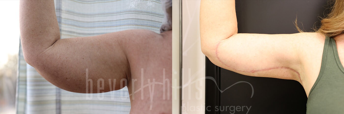 Arm Lift Patient 05 Before & After