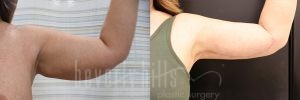 Arm Lift Patient 05 Before & After - Thumbnail