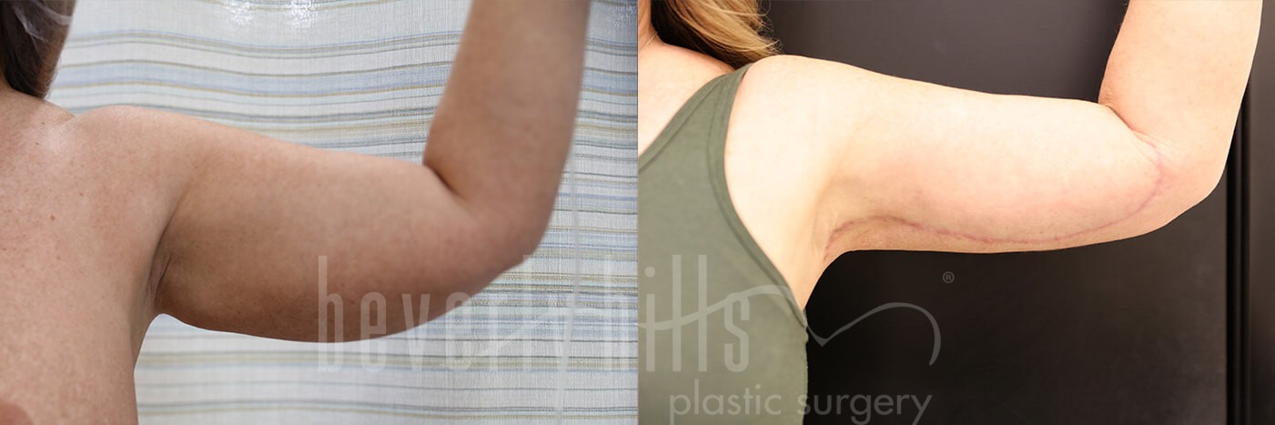 Arm Lift Patient 05 Before & After