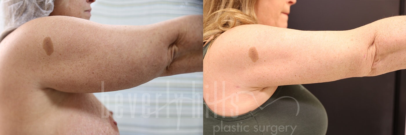 Arm Lift Patient 05 Before & After