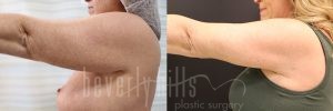 Arm Lift Patient 05 Before & After - Thumbnail