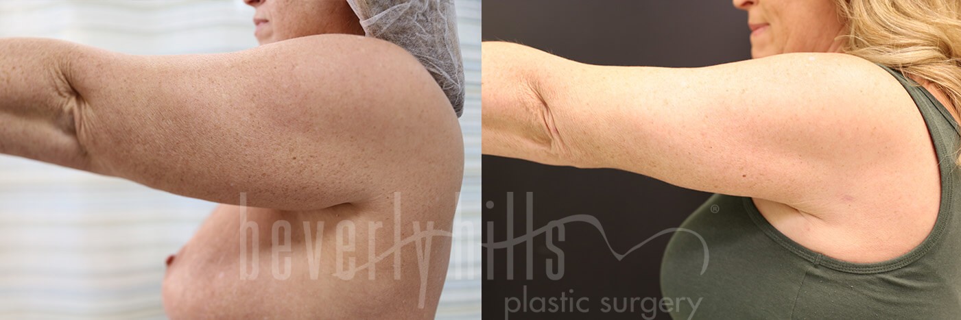 Arm Lift Patient 05 Before & After