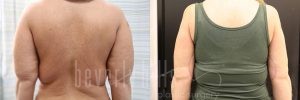 Arm Lift Patient 05 Before & After - Thumbnail