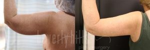 Arm Lift Patient 05 Before & After - Thumbnail