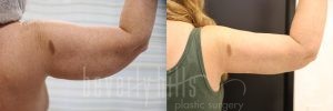 Arm Lift Patient 05 Before & After - Thumbnail