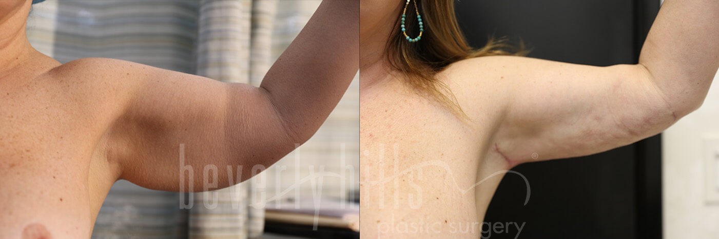 Arm Lift Patient 06 Before & After