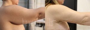 Arm Lift Patient 06 Before & After - Thumbnail