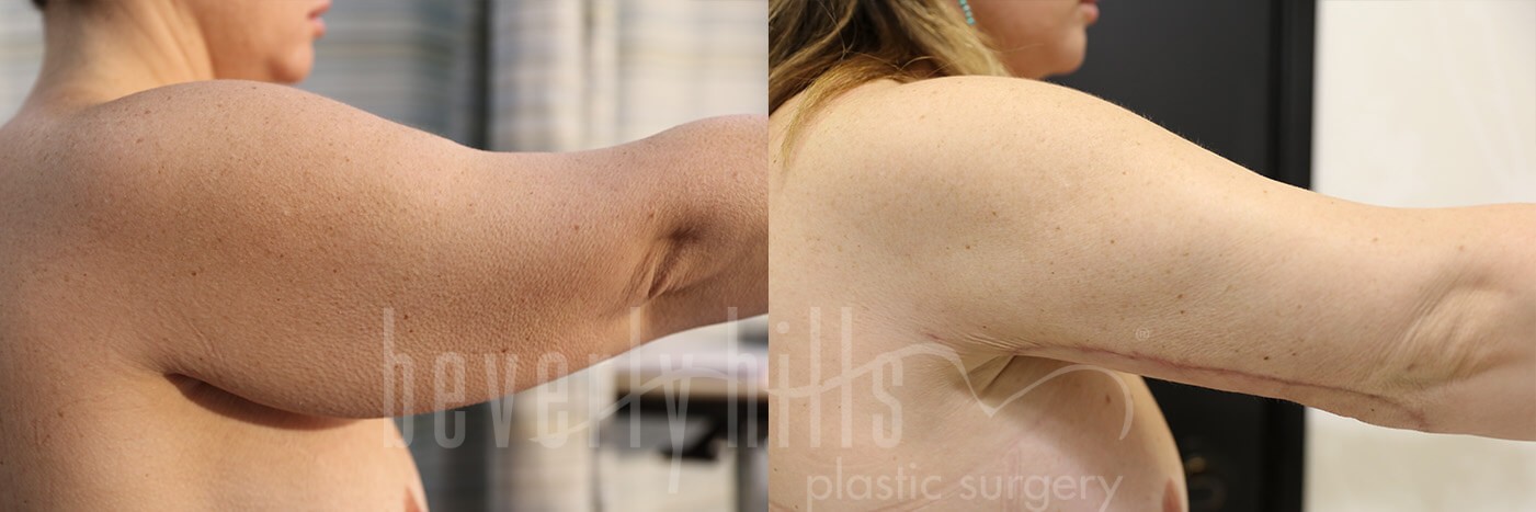 Arm Lift Patient 06 Before & After