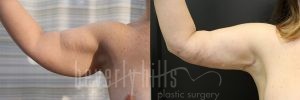 Arm Lift Patient 06 Before & After - Thumbnail