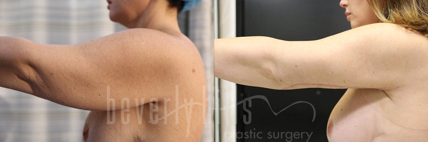 Arm Lift Patient 06 Before & After