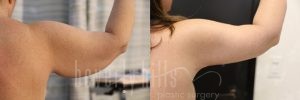 Arm Lift Patient 06 Before & After - Thumbnail