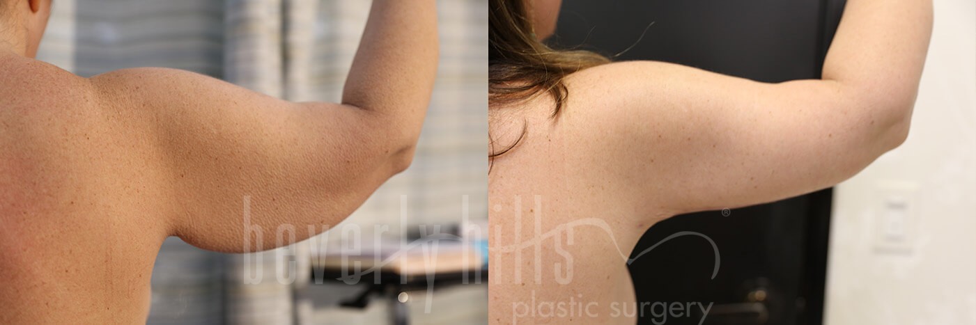 Arm Lift Patient 06 Before & After