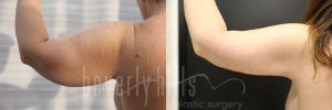 Arm Lift Patient 06 Before & After - Thumbnail