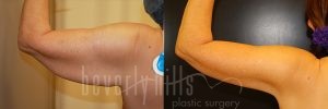 Arm Lift Patient 07 Before & After - Thumbnail
