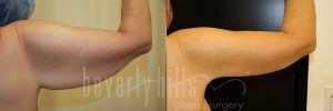 Arm Lift Patient 07 Before & After - Thumbnail