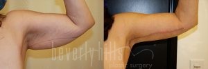 Arm Lift Patient 07 Before & After - Thumbnail
