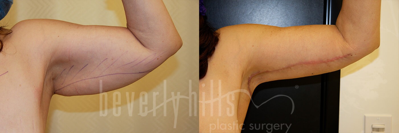 Arm Lift Patient 07 Before & After