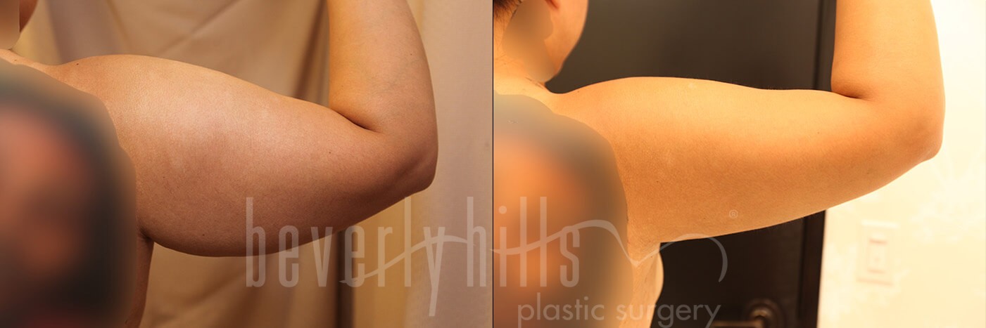 Arm Lift Patient 08 Before & After