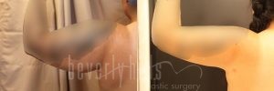 Arm Lift Patient 08 Before & After - Thumbnail