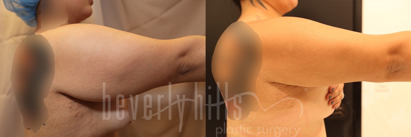 Arm Lift Patient 08 Before & After