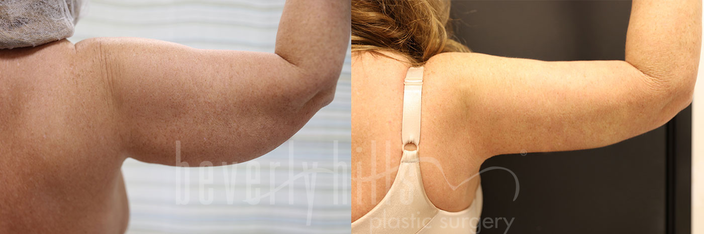 Arm Lift Patient 01 Before & After