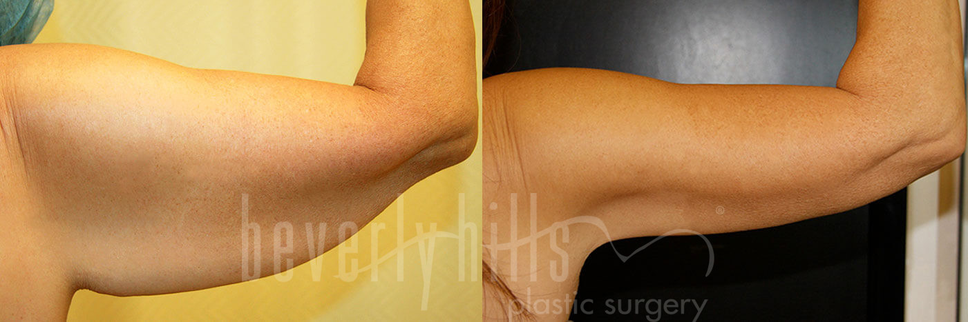 ARM LIFT PATIENT 02 Before & After